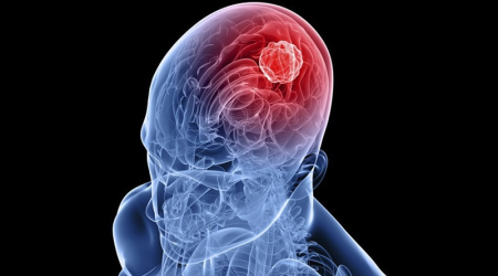Arteriovenöz Malformasyonlar (AVM)
