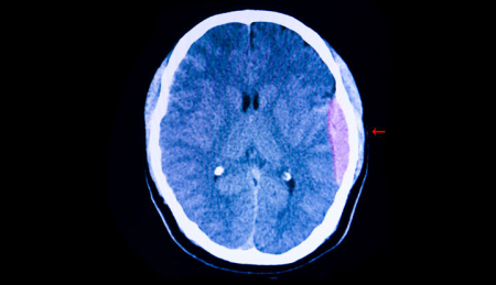Epidural Hematom