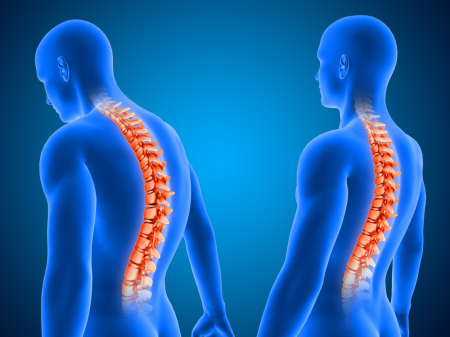 Spinal Stenoz (Omurga Kanal Darlığı)